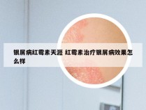 银屑病红霉素天涯 红霉素治疗银屑病效果怎么样
