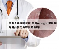 澳洲人会得银屑病 澳洲moogoo银屑病专用药膏怎么样有激素吗?