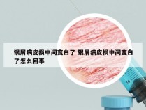 银屑病皮损中间变白了 银屑病皮损中间变白了怎么回事