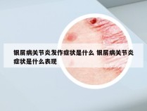 银屑病关节炎发作症状是什么 银屑病关节炎症状是什么表现