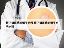 得了银屑病能喝牛奶吗 得了银屑病能喝牛奶吗小孩