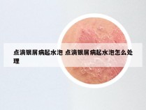 点滴银屑病起水泡 点滴银屑病起水泡怎么处理
