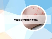 牛皮癣可使用哪种洗发水