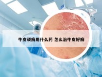 牛皮顽癣用什么药 怎么治牛皮好癣