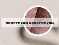 银屑病会扩散全身吗 银屑病会扩散到全身吗