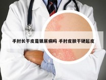 手肘长干皮是银屑病吗 手肘皮肤干硬起皮