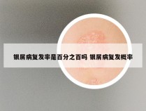 银屑病复发率是百分之百吗 银屑病复发概率