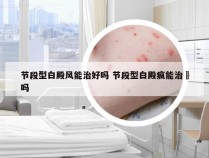 节段型白殿风能治好吗 节段型白殿疯能治瘉吗