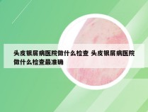 头皮银屑病医院做什么检查 头皮银屑病医院做什么检查最准确