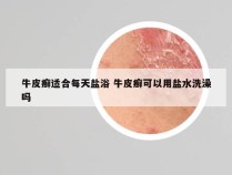 牛皮癣适合每天盐浴 牛皮癣可以用盐水洗澡吗