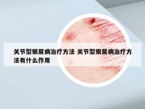 关节型银屑病治疗方法 关节型银屑病治疗方法有什么作用