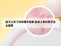 肚子上长了红块像牛皮癣 肚皮上有红疹子怎么回事