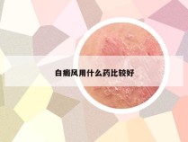 白癜风用什么药比较好