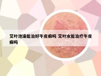 艾叶泡澡能治好牛皮癣吗 艾叶水能治疗牛皮癣吗
