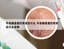 牛皮癣患者饮食禁忌什么 牛皮癣患者饮食禁忌什么食物