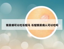 银屑病可以吃石榴马 石榴银屑病人可以吃吗