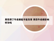 男性得了牛皮癣能不能生育 男性牛皮癣影响怀孕吗