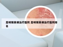昆明银屑病治疗医院 昆明银屑病治疗医院排名