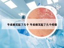 牛皮癣又起了几个 牛皮癣又起了几个疙瘩