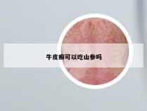 牛皮癣可以吃山参吗