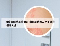 治疗银屑病单验偏方 治银屑病的三个小偏方 偏方大全