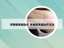 早期银屑病治疗 早期银屑病治疗方法