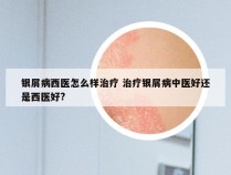 银屑病西医怎么样治疗 治疗银屑病中医好还是西医好?