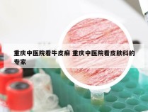 重庆中医院看牛皮癣 重庆中医院看皮肤科的专家