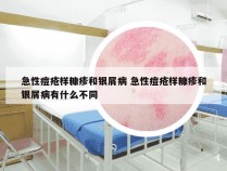 急性痘疮样糠疹和银屑病 急性痘疮样糠疹和银屑病有什么不同