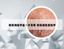 银屑病指甲盖一半发黄 银屑病患者指甲