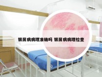 银屑病病理准确吗 银屑病病理检查