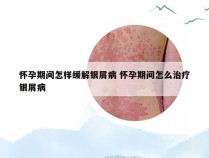 怀孕期间怎样缓解银屑病 怀孕期间怎么治疗银屑病