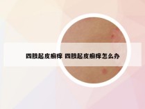 四肢起皮癣痒 四肢起皮癣痒怎么办