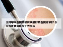 衡阳哪家医院的银屑病最好的医院哪家好 衡阳市皮肤病医院十大排名