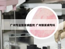 广州专业银屑病医院 广州银屑病专科