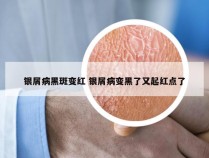 银屑病黑斑变红 银屑病变黑了又起红点了