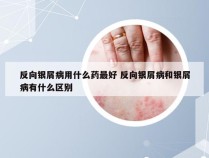 反向银屑病用什么药最好 反向银屑病和银屑病有什么区别