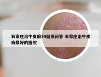 石家庄治牛皮癣39健康问答 石家庄治牛皮癣最好的医院
