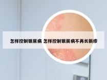 怎样控制银屑病 怎样控制银屑病不再长新疹