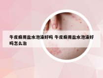 牛皮癣用盐水泡澡好吗 牛皮癣用盐水泡澡好吗怎么治