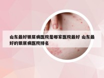 山东最好银屑病医院是哪家医院最好 山东最好的银屑病医院排名