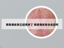银屑病皮损已经很单了 银屑病皮损会自愈吗