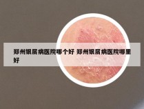 郑州银屑病医院哪个好 郑州银屑病医院哪里好