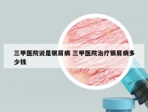 三甲医院说是银屑病 三甲医院治疗银屑病多少钱