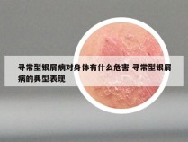 寻常型银屑病对身体有什么危害 寻常型银屑病的典型表现