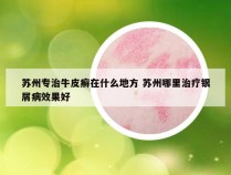 苏州专治牛皮癣在什么地方 苏州哪里治疗银屑病效果好