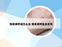银屑病甲减怎么治 银屑病甲能自愈吗