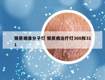 银屑病准分子灯 银屑病治疗灯308和311