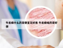 牛皮癣什么药膏便宜又好用 牛皮癣啥药膏好使