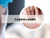 牛皮癣影响人体健康吗